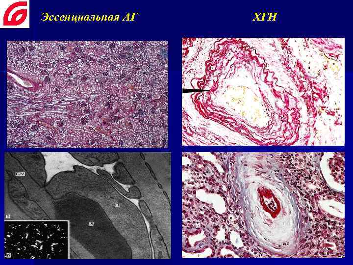 Эссенциальная АГ ХГН 