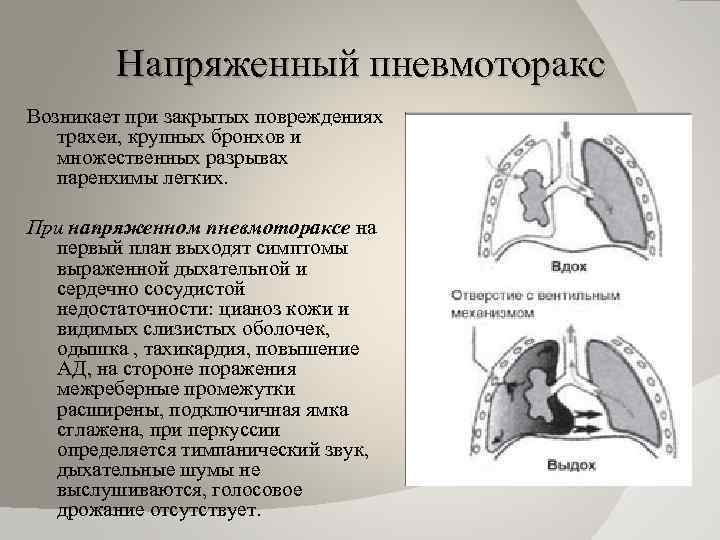 Напряженный пневмоторакс Возникает при закрытых повреждениях трахеи, крупных бронхов и множественных разрывах паренхимы легких.