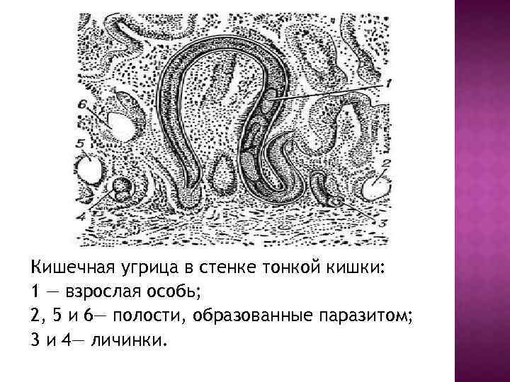 Кишечная угрица в стенке тонкой кишки: 1 — взрослая особь; 2, 5 и 6—