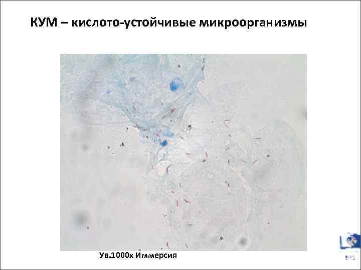 КУМ – кислото-устойчивые микроорганизмы Ув. 1000 х Иммерсия 