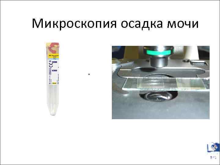 Микроскопия осадка мочи 