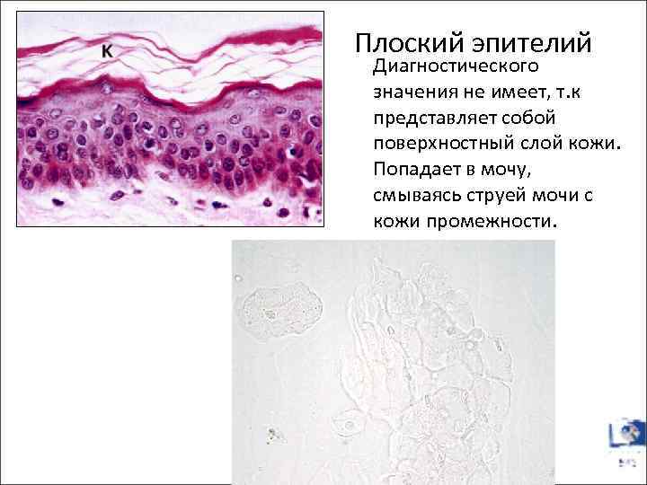 Плоский эпителий Диагностического значения не имеет, т. к представляет собой поверхностный слой кожи. Попадает