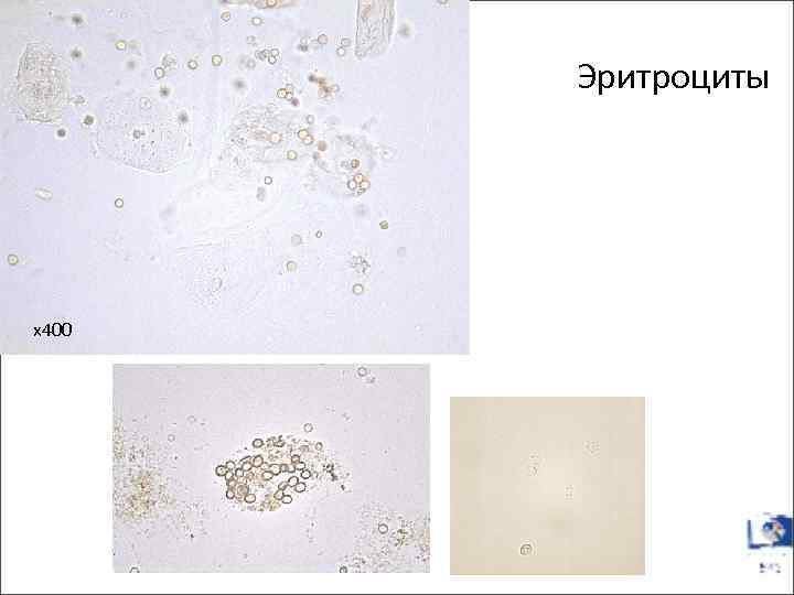 Эритроциты х400 
