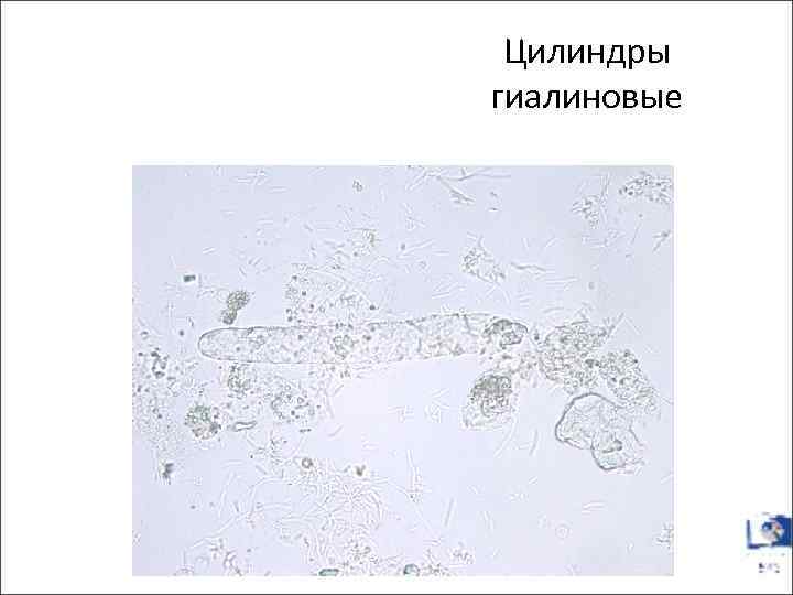 Цилиндры гиалиновые 