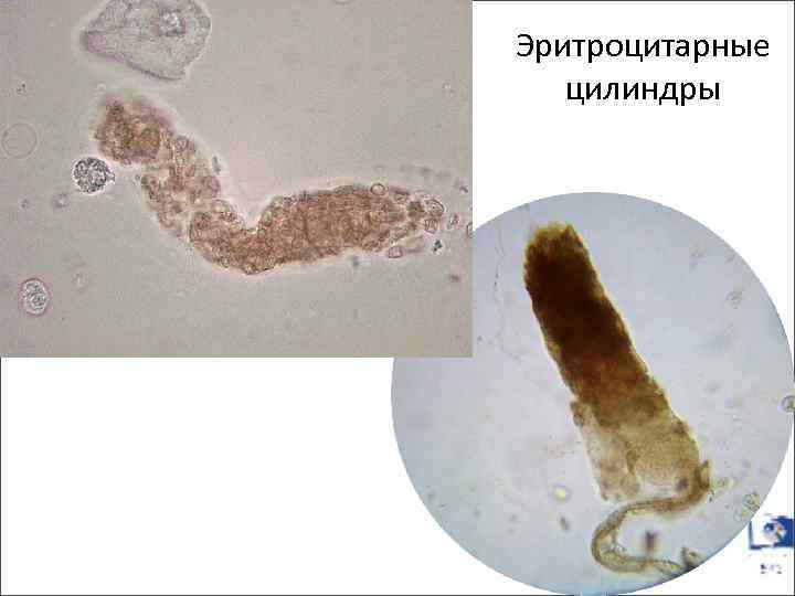Эритроцитарные цилиндры 