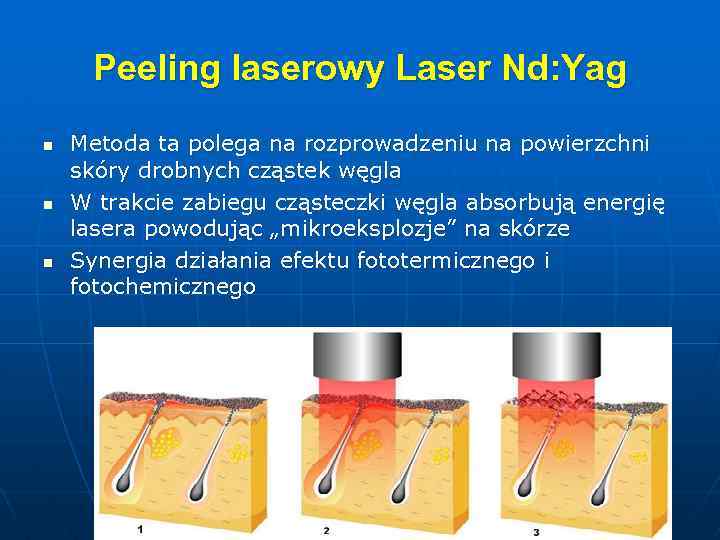 Peeling laserowy Laser Nd: Yag n n n Metoda ta polega na rozprowadzeniu na