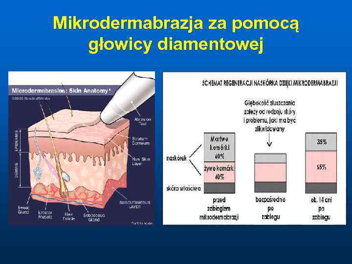 Mikrodermabrazja za pomocą głowicy diamentowej 