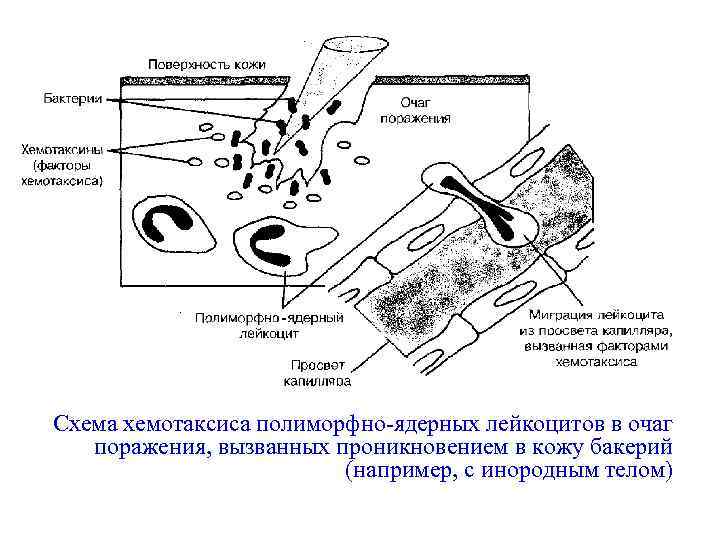 Схема хемотаксиса полиморфно-ядерных лейкоцитов в очаг поражения, вызванных проникновением в кожу бакерий (например, с