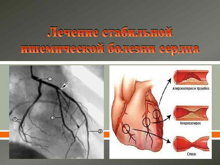 Стабильная ишемическая болезнь сердца презентация