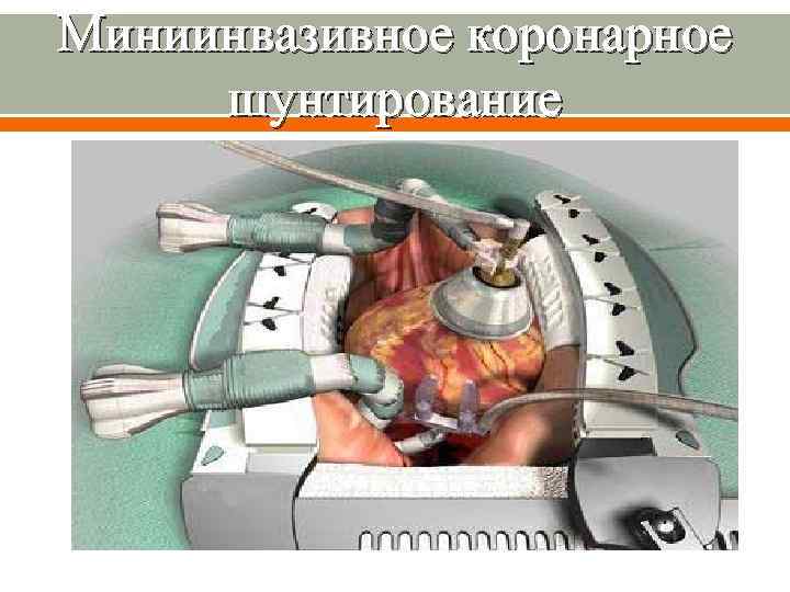 Миниинвазивное коронарное шунтирование 