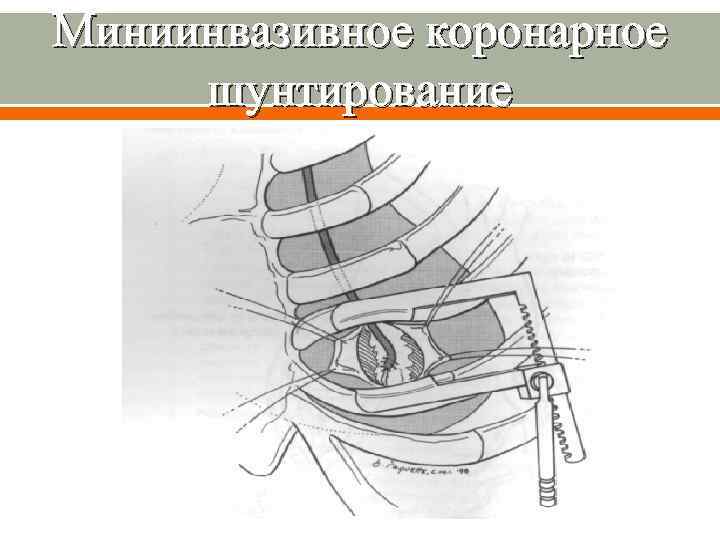 Через боковую. Миниинвазивное коронарное шунтирование. Малоинвазивное коронарное шунтирование. Коронарное шунтирование реабилитация. Разрез при коронарном шунтировании.