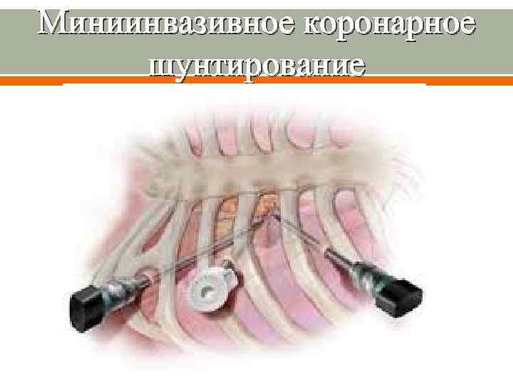 Миниинвазивное коронарное шунтирование 