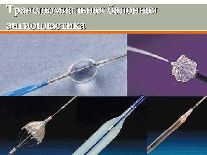 Транслюмиальная балонная ангиопластика 