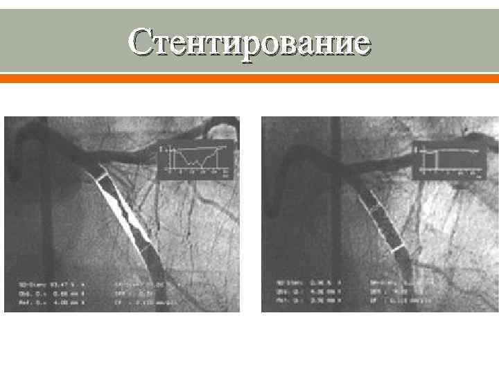 Стентирование 