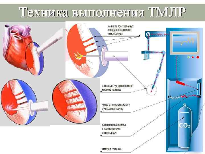 Техника выполнения ТМЛР 3 
