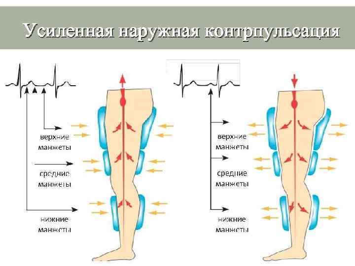 Усиленная наружная контрпульсация 
