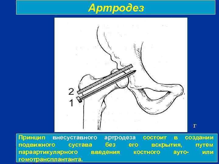 Артродез г Принцип внесуставного артродеза состоит в создании подвижного сустава без его вскрытия, путем