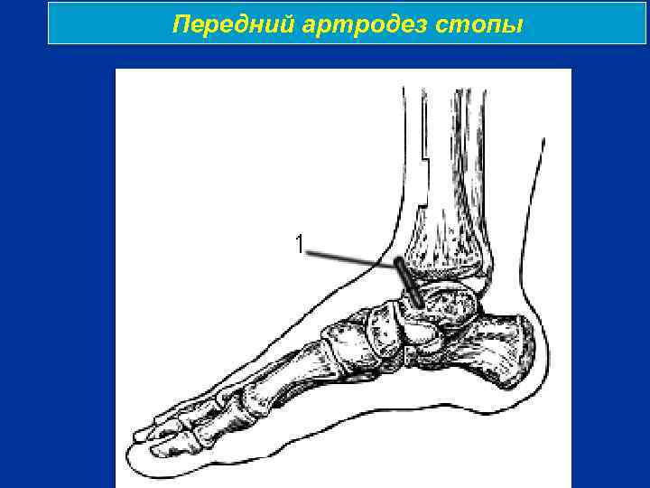 Передний артродез стопы 