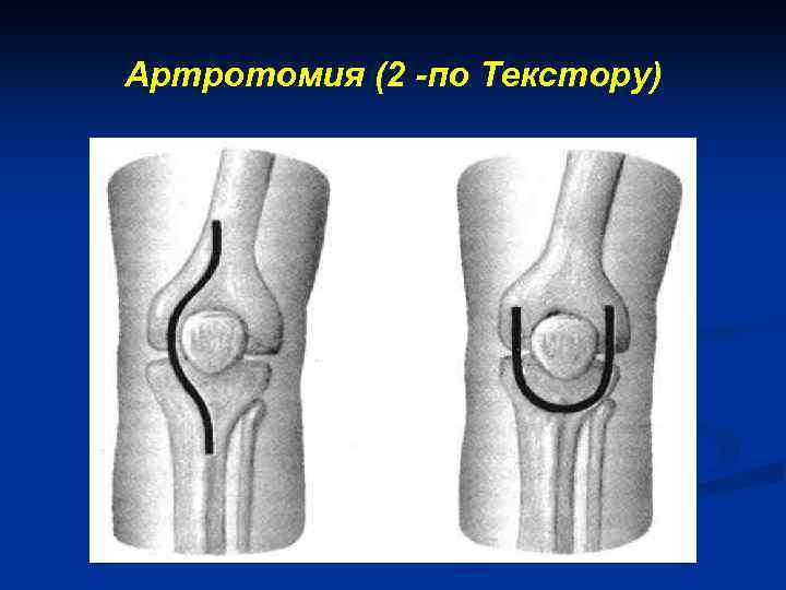 Артротомия (2 -по Текстору) 