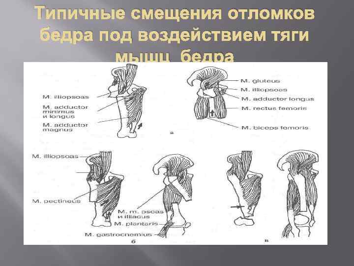 Типичные смещения отломков бедра под воздействием тяги мышц бедра 