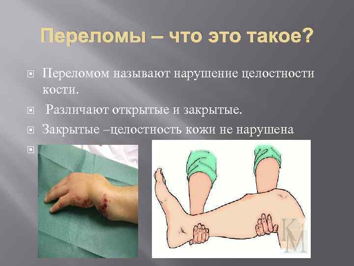 Переломы – что это такое? Переломом называют нарушение целостности кости. Различают открытые и закрытые.