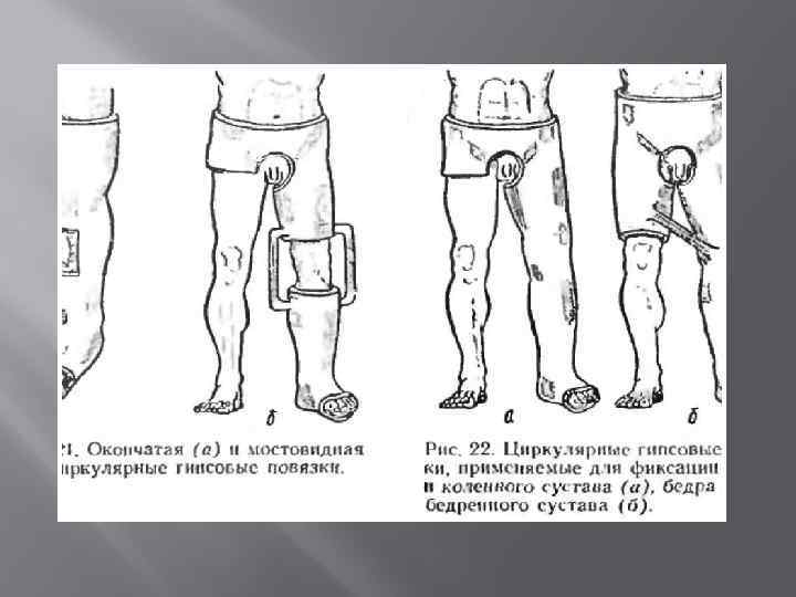 Циркулярная гипсовая повязка. Кокситная гипсовая повязка при переломе.