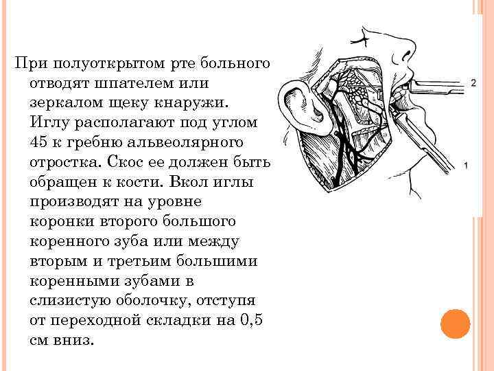 При полуоткрытом рте больного отводят шпателем или зеркалом щеку кнаружи. Иглу располагают под углом