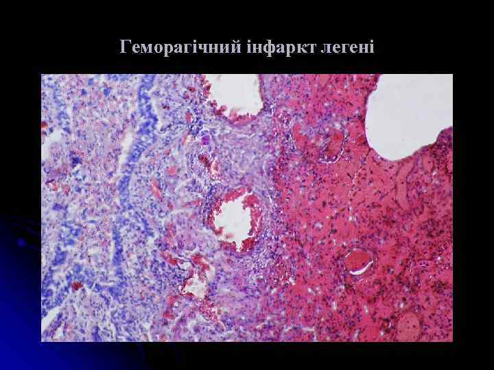 Геморагічний інфаркт легені 