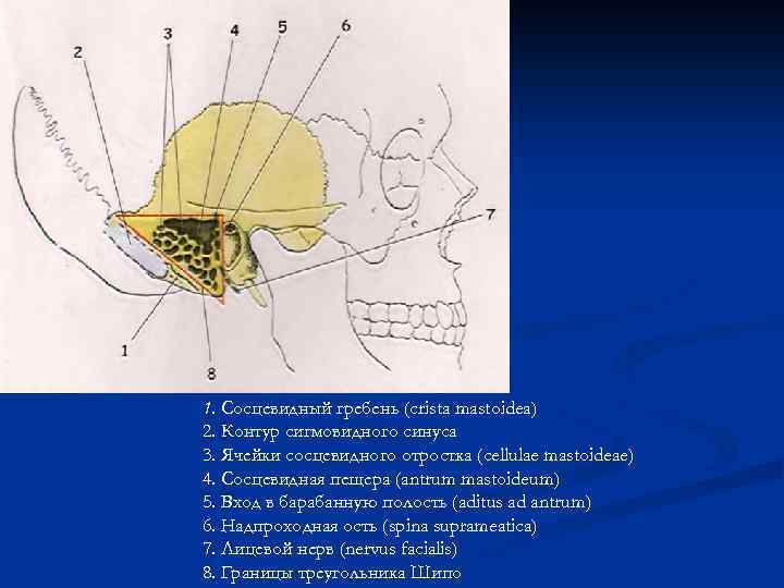 1. Сосцевидный гребень (crista mastoidea) 2. Контур сигмовидного синуса 3. Ячейки сосцевидного отростка (cellulae