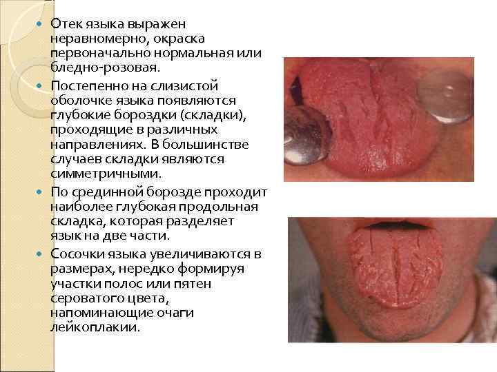 Отек языка выражен неравномерно, окраска первоначально нормальная или бледно-розовая. Постепенно на слизистой оболочке языка