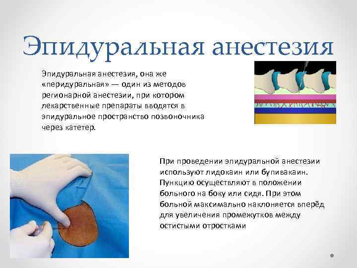Эпидуральная анестезия, она же «перидуральная» — один из методов регионарной анестезии, при котором лекарственные