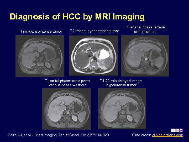 Diagnosis of HCC by MRI Imaging T 1 image: isointense tumor T 2 image: