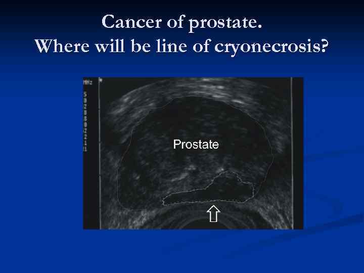 Cancer of prostate. Where will be line of cryonecrosis? 