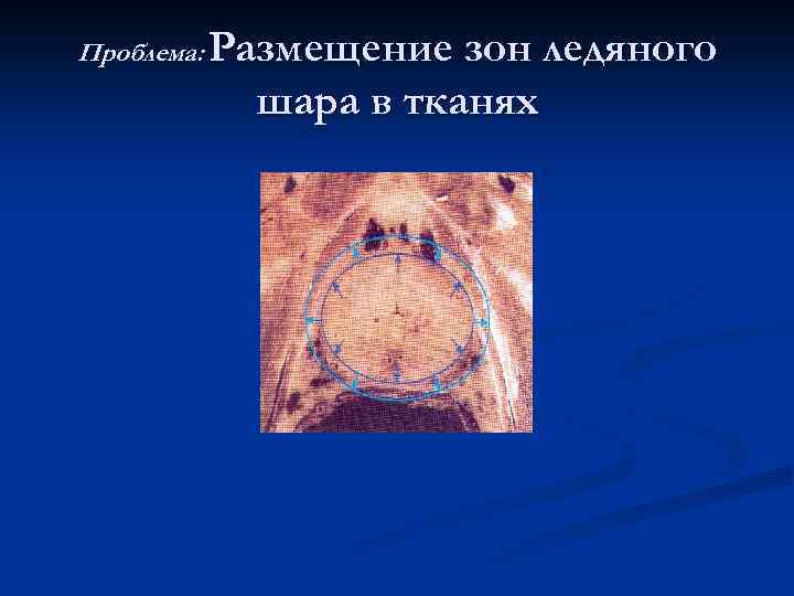 Проблема: Размещение зон ледяного шара в тканях 