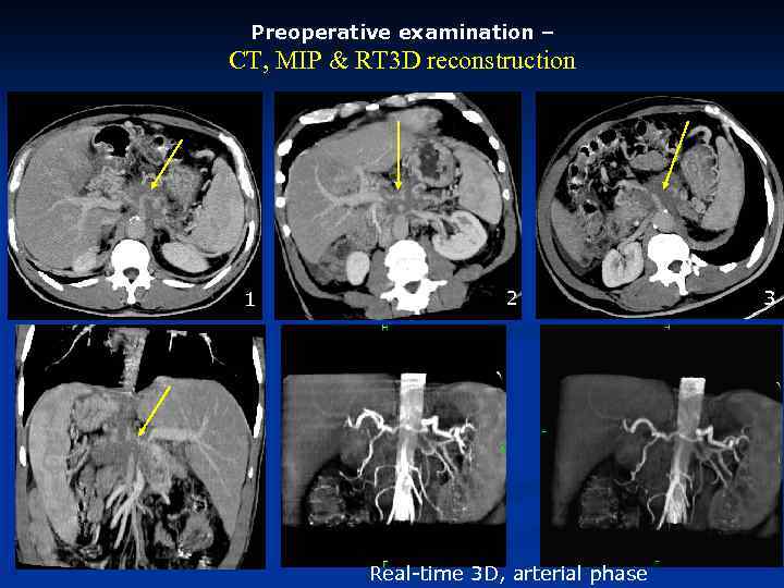 Preoperative examination – CT, MIP & RT 3 D reconstruction 1 2 Real-time 3