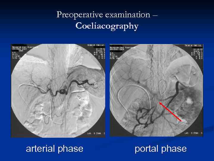Preoperative examination – Coeliacography arterial phase portal phase 