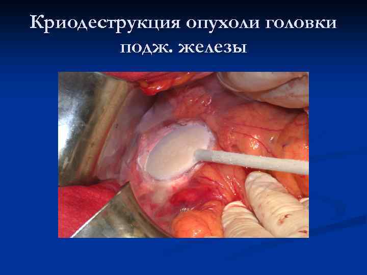 Криодеструкция опухоли головки подж. железы 