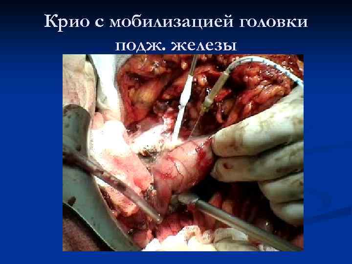 Крио с мобилизацией головки подж. железы 