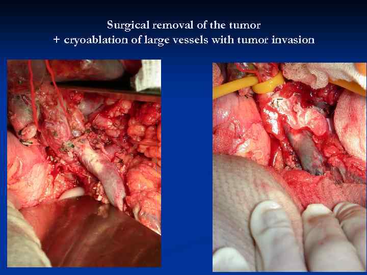 Surgical removal of the tumor + cryoablation of large vessels with tumor invasion 