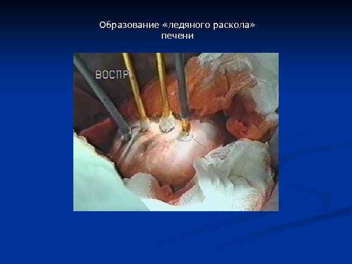 Образование «ледяного раскола» печени 