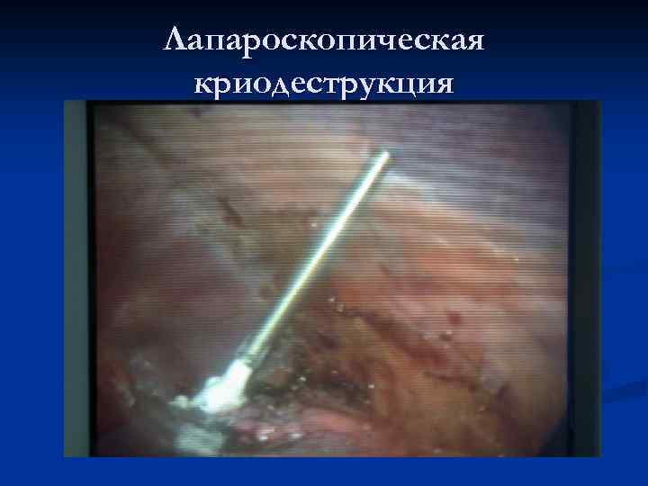 Лапароскопическая криодеструкция 