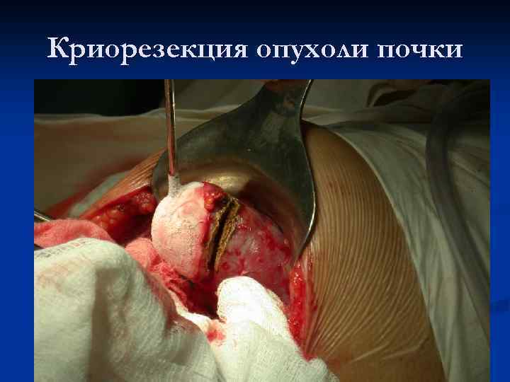 Криорезекция опухоли почки 