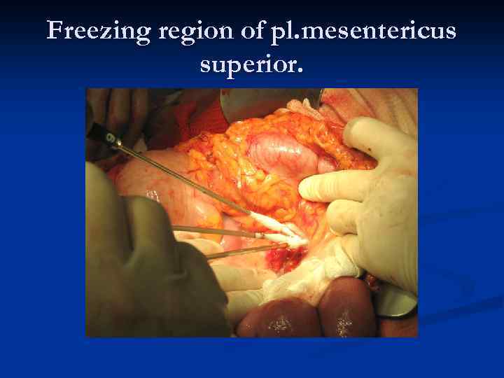 Freezing region of pl. mesentericus superior. 