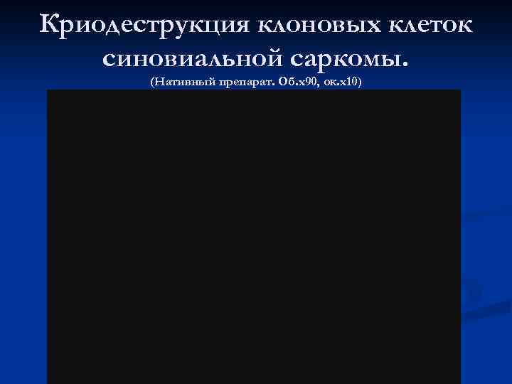 Криодеструкция клоновых клеток синовиальной саркомы. (Нативный препарат. Об. х90, ок. х10) 
