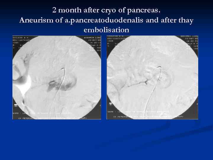 2 month after cryo of pancreas. Aneurism of a. pancreatoduodenalis and after thay embolisation