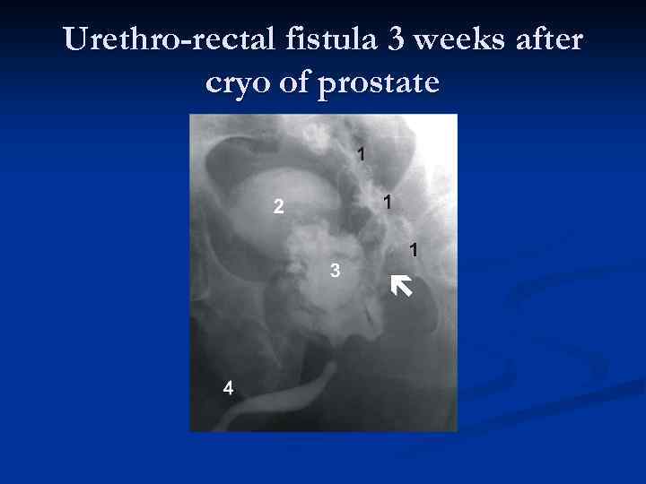 Urethro-rectal fistula 3 weeks after cryo of prostate 