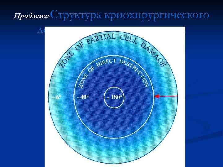 Проблема: Структура криохирургического ледяного шара не однородна 