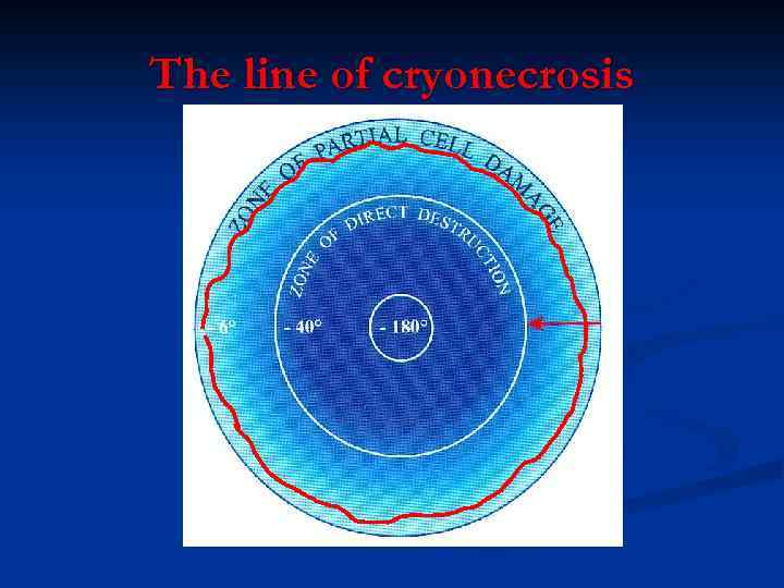The line of cryonecrosis 