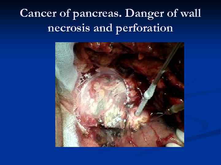 Cancer of pancreas. Danger of wall necrosis and perforation 