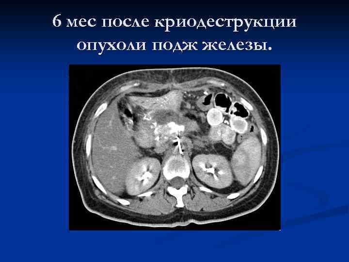 6 мес после криодеструкции опухоли подж железы. 
